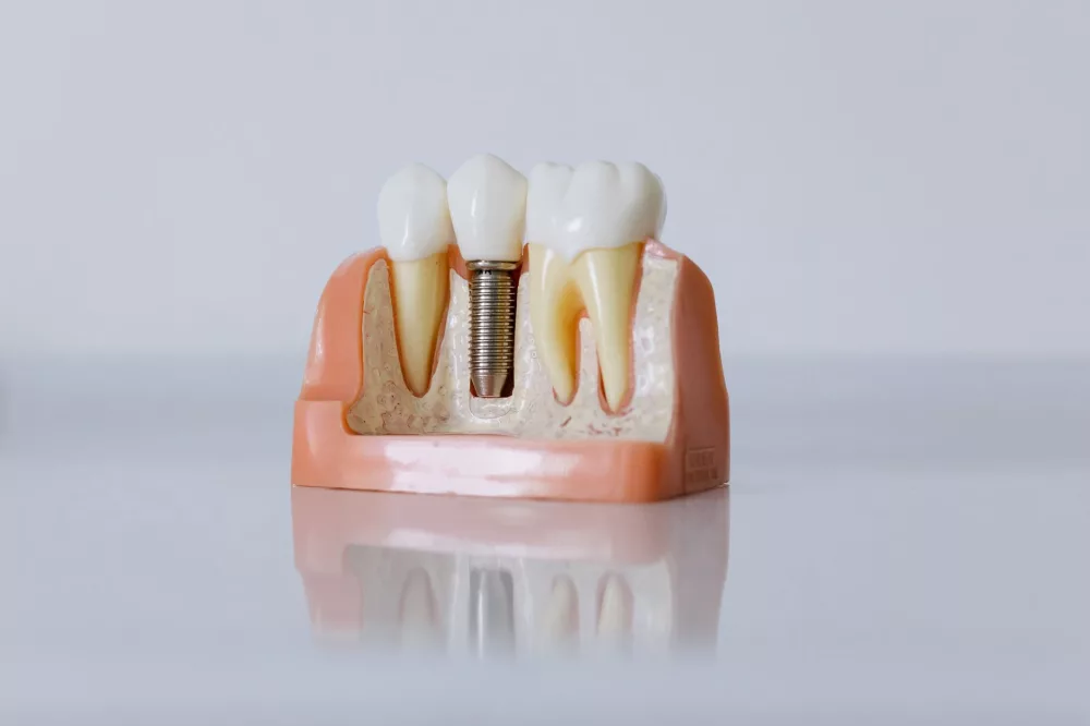 Full Mouth Dental Implants Cost: A Comprehensive Investment Guide
